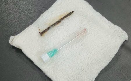 Kasus Medis Tak Biasa: Dokter RSUD Arifin Achmad Selamatkan Pasien dengan Paku di Paru-paru