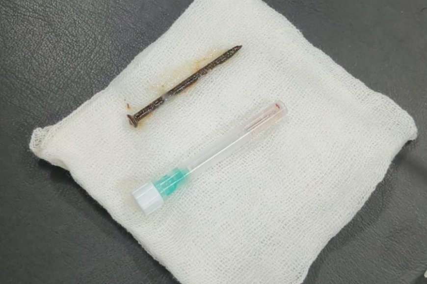 Kasus Medis Tak Biasa: Dokter RSUD Arifin Achmad Selamatkan Pasien dengan Paku di Paru-paru